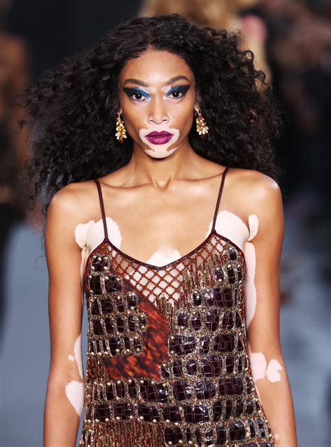 fashion model with vitiligo